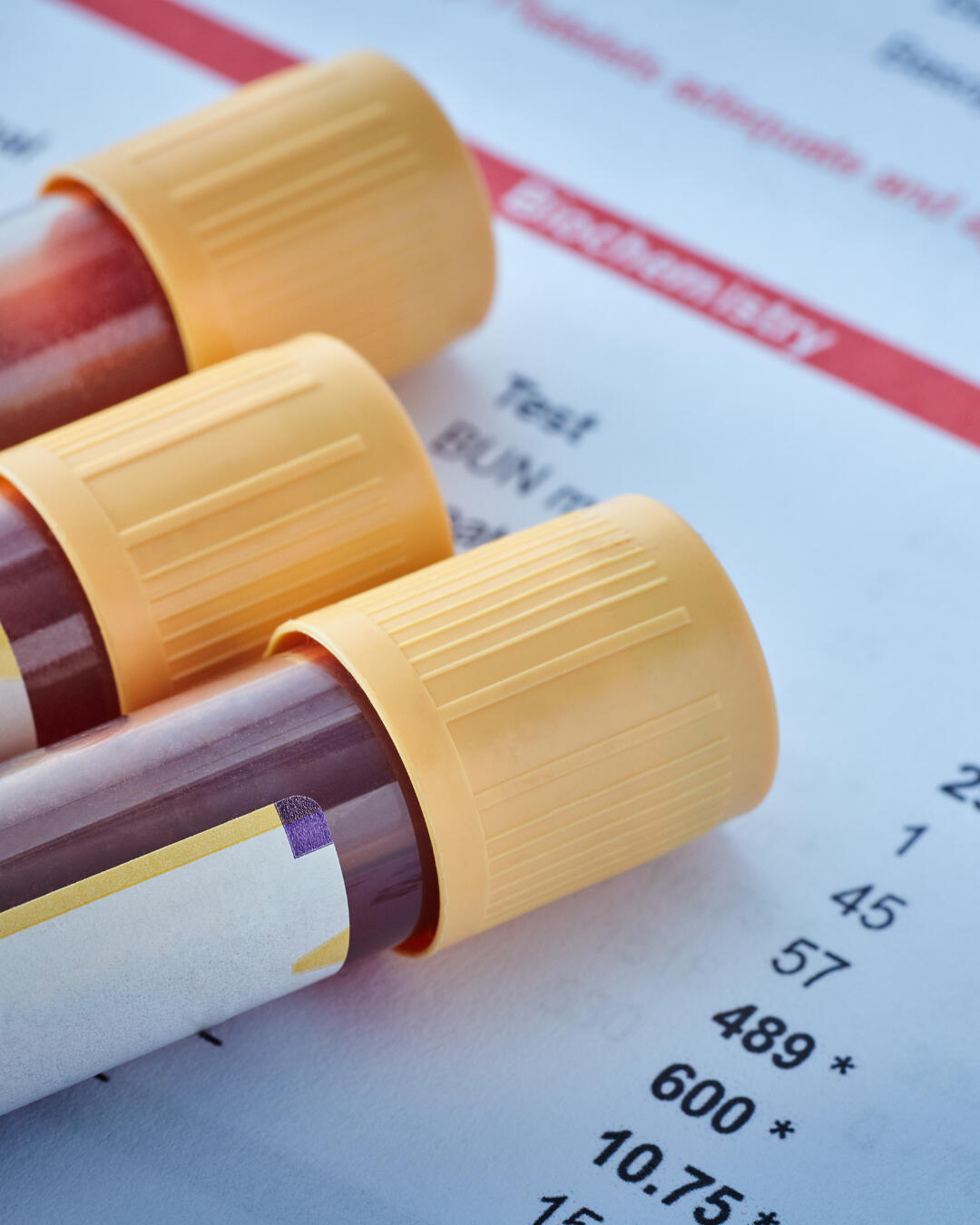 Close-up of yellow-capped blood collection tubes placed on a printed lab results sheet